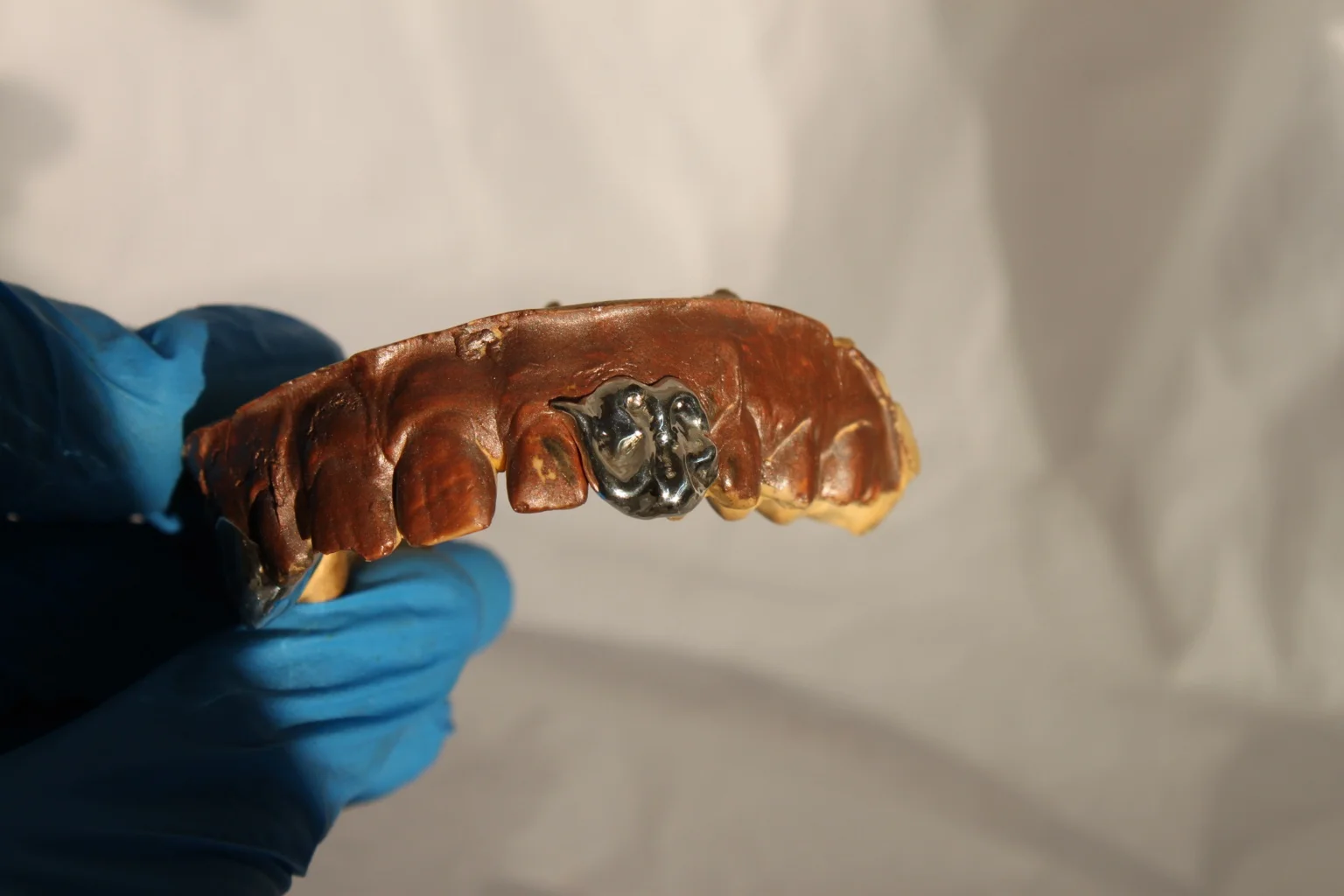 A dark metal tooth cap set into a rough model of the teeth, held in blue gloves