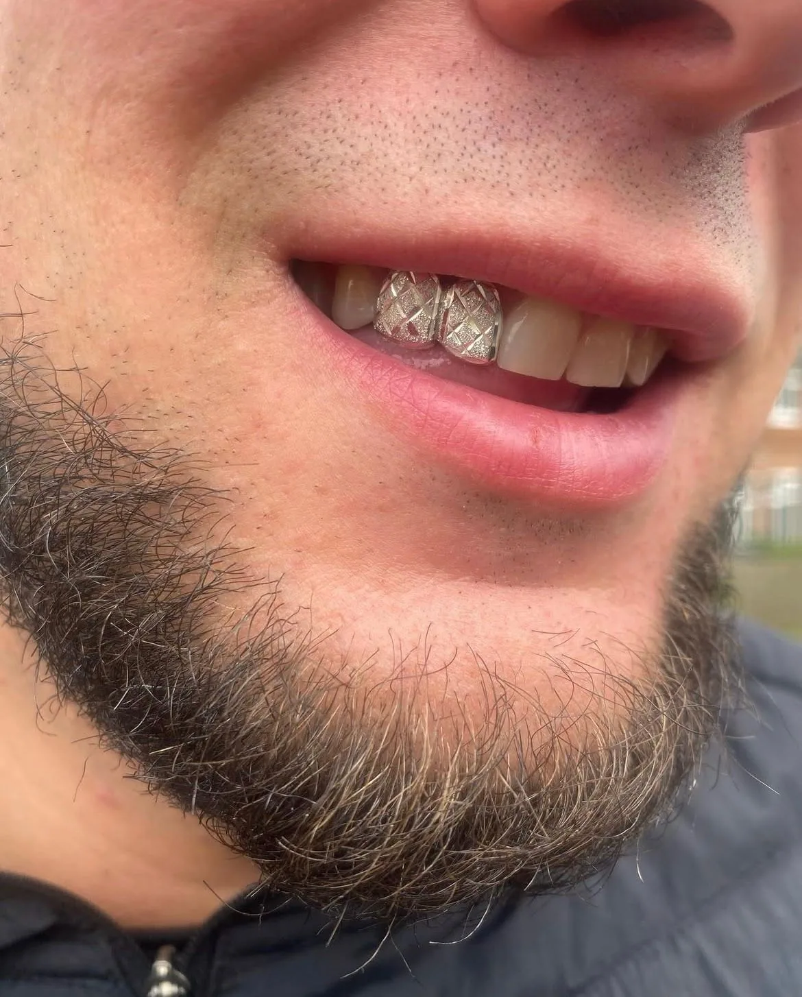 Two diamond-cut patterned silver grillz caps on front teeth