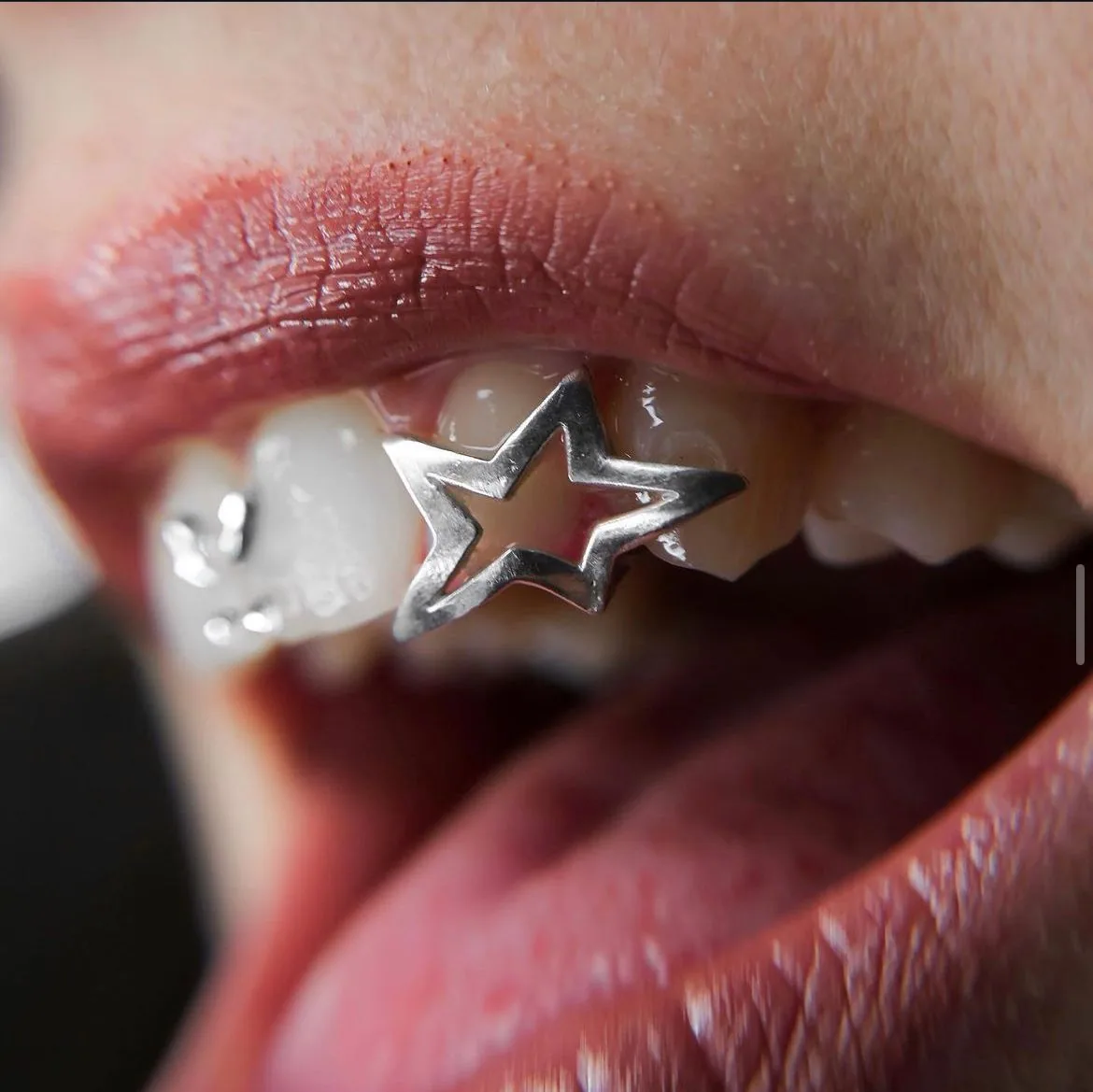 A star-shaped custom silver tooth cap on a back tooth