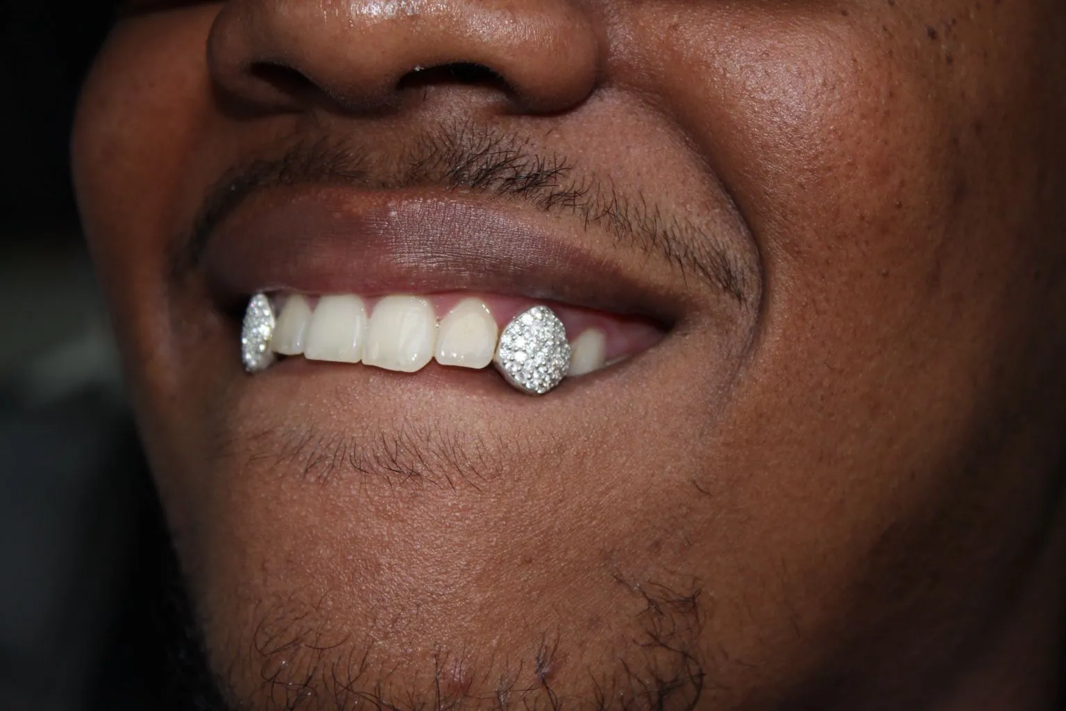 Close-up of a wide smile with diamond-set grillz on both canines