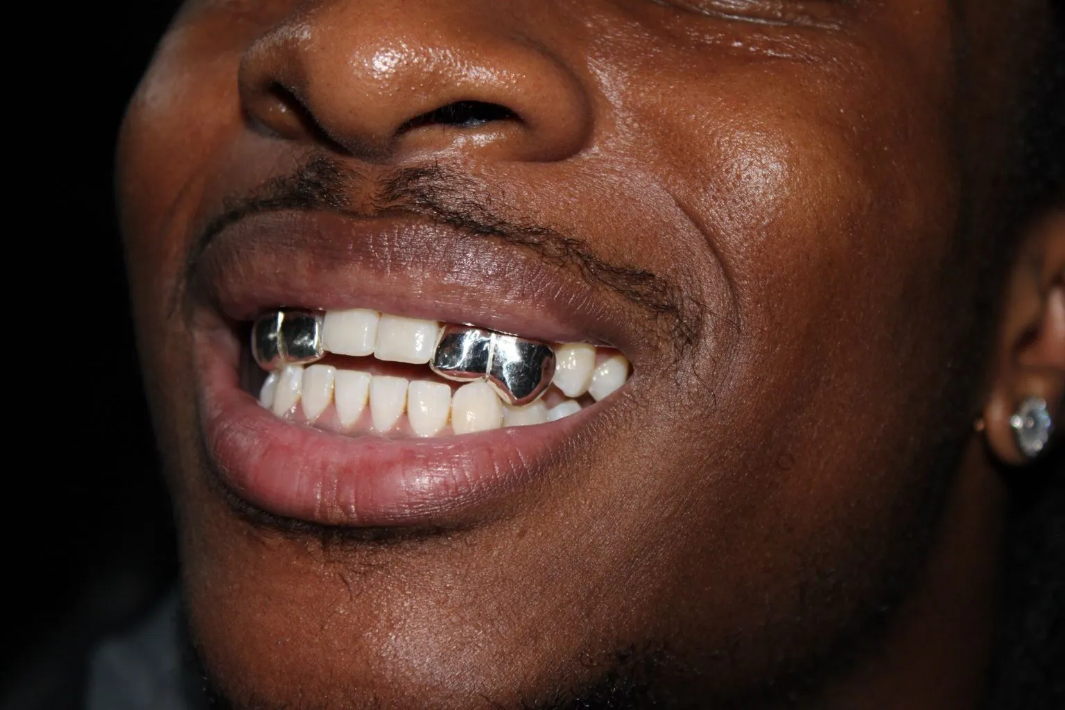 Close-up of a polished silver grillz cap on a single front tooth