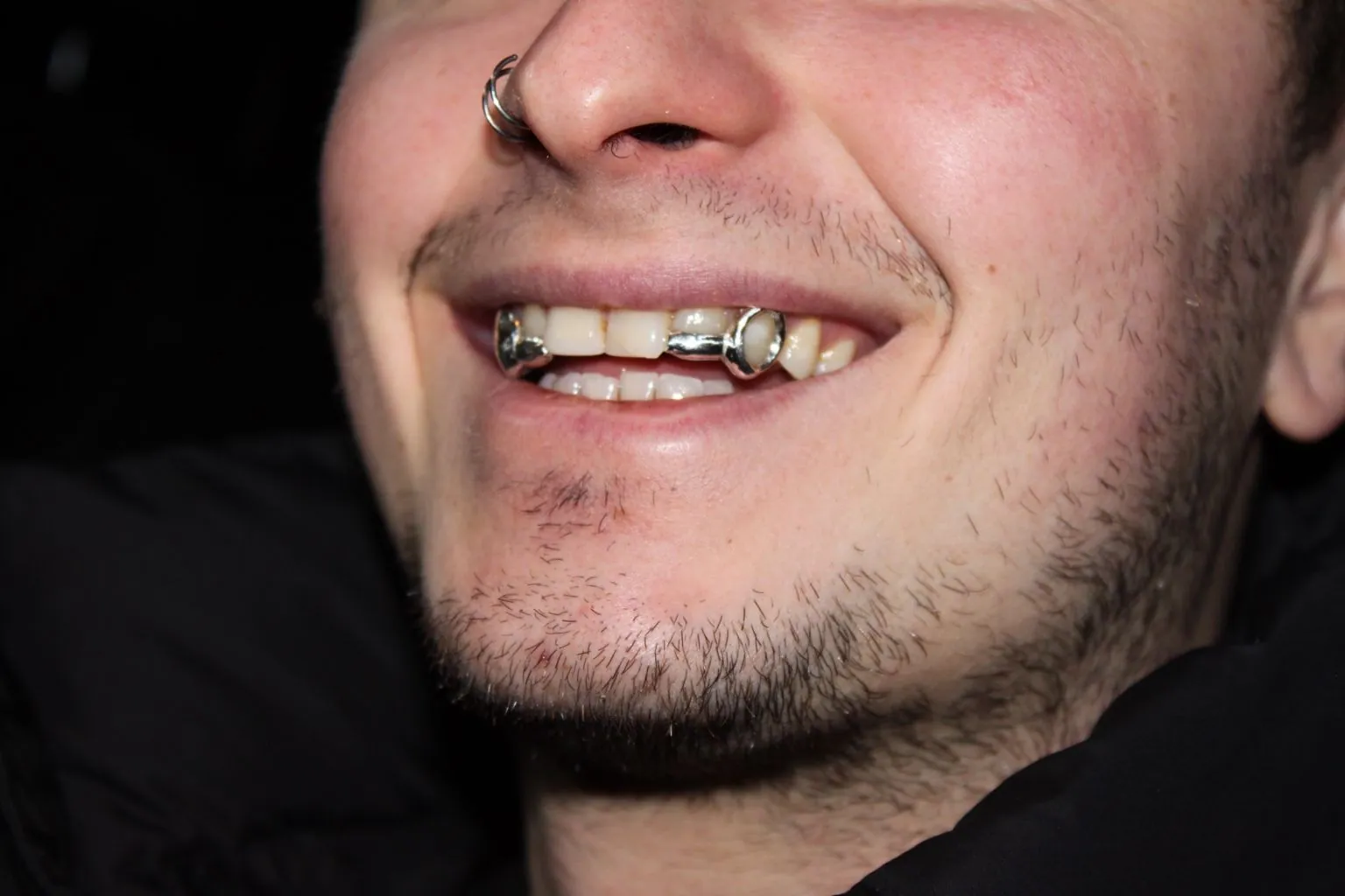 Close-up of a smile with a polished silver grillz cap on a front tooth