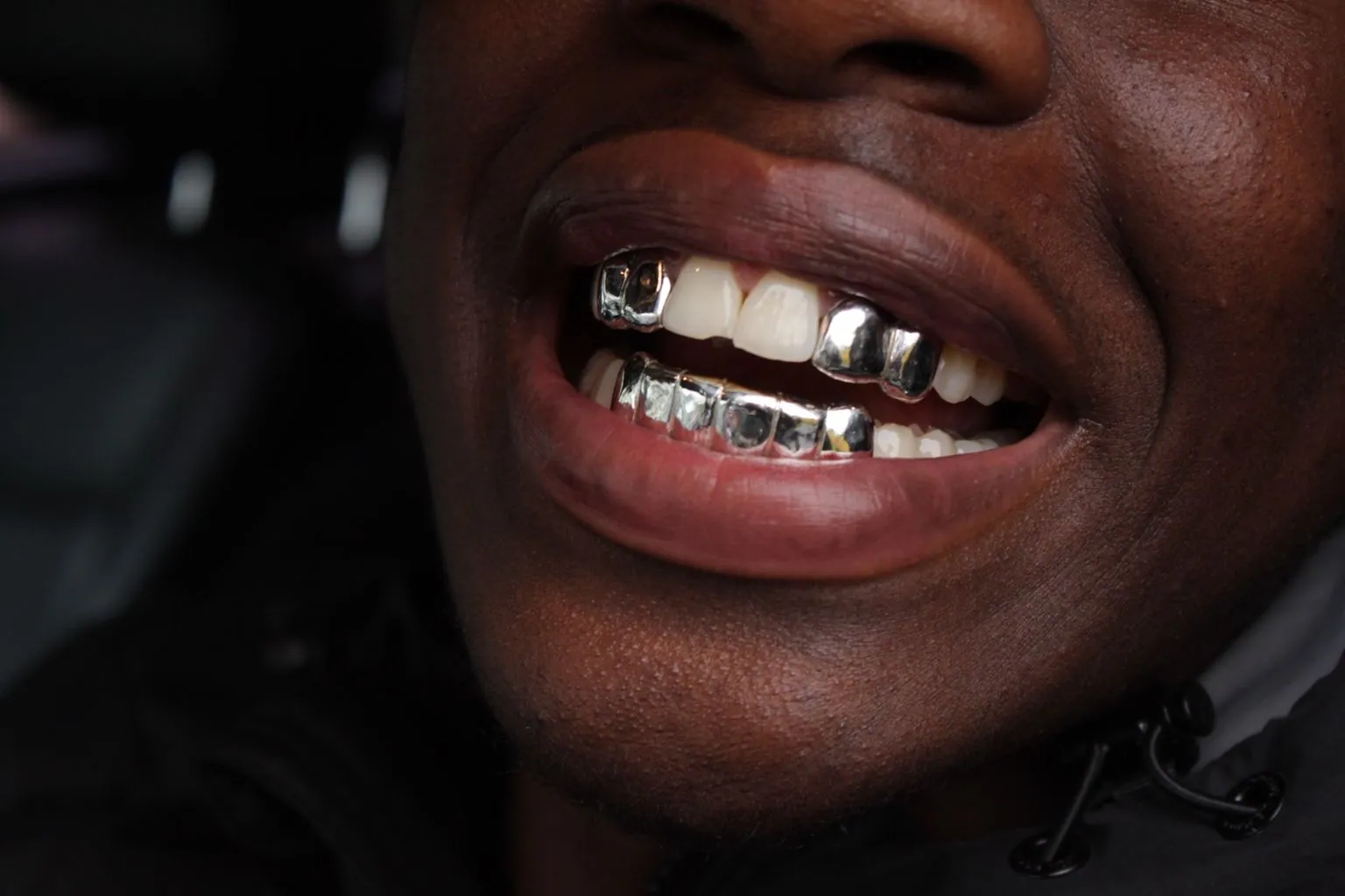 Close-up of silver grillz caps on the front teeth in a wide smile